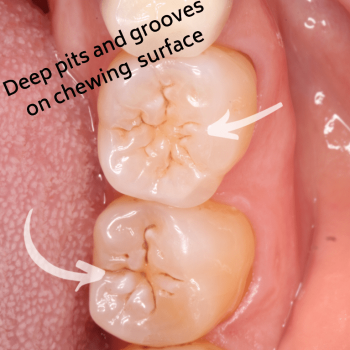 Caries clinical dentistry dental diagnosis grading tooth management smooth occlusal surfaces severity criteria icdas teeth lesion scale radiographs using activity